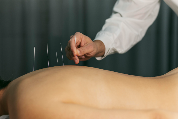 Acupuntura